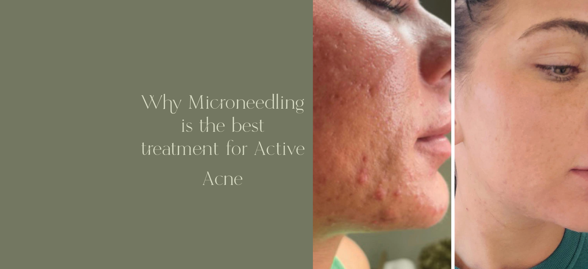 before and after result of microneedling for acne