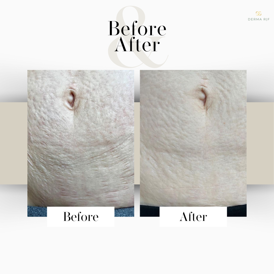 Radio Frequency Microneedling Body Package x4 - Launch Offer