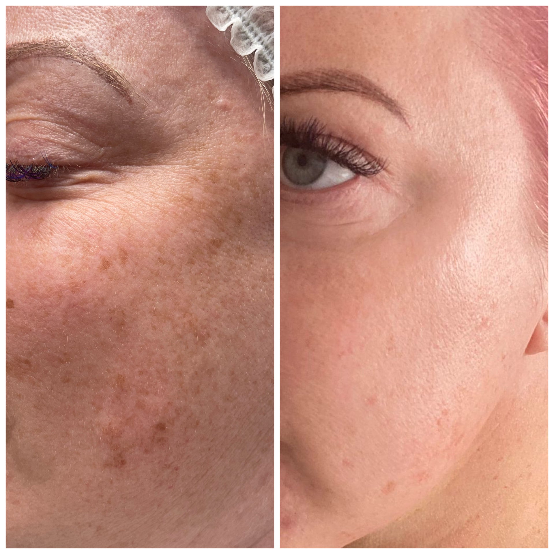 Microneedling Facial