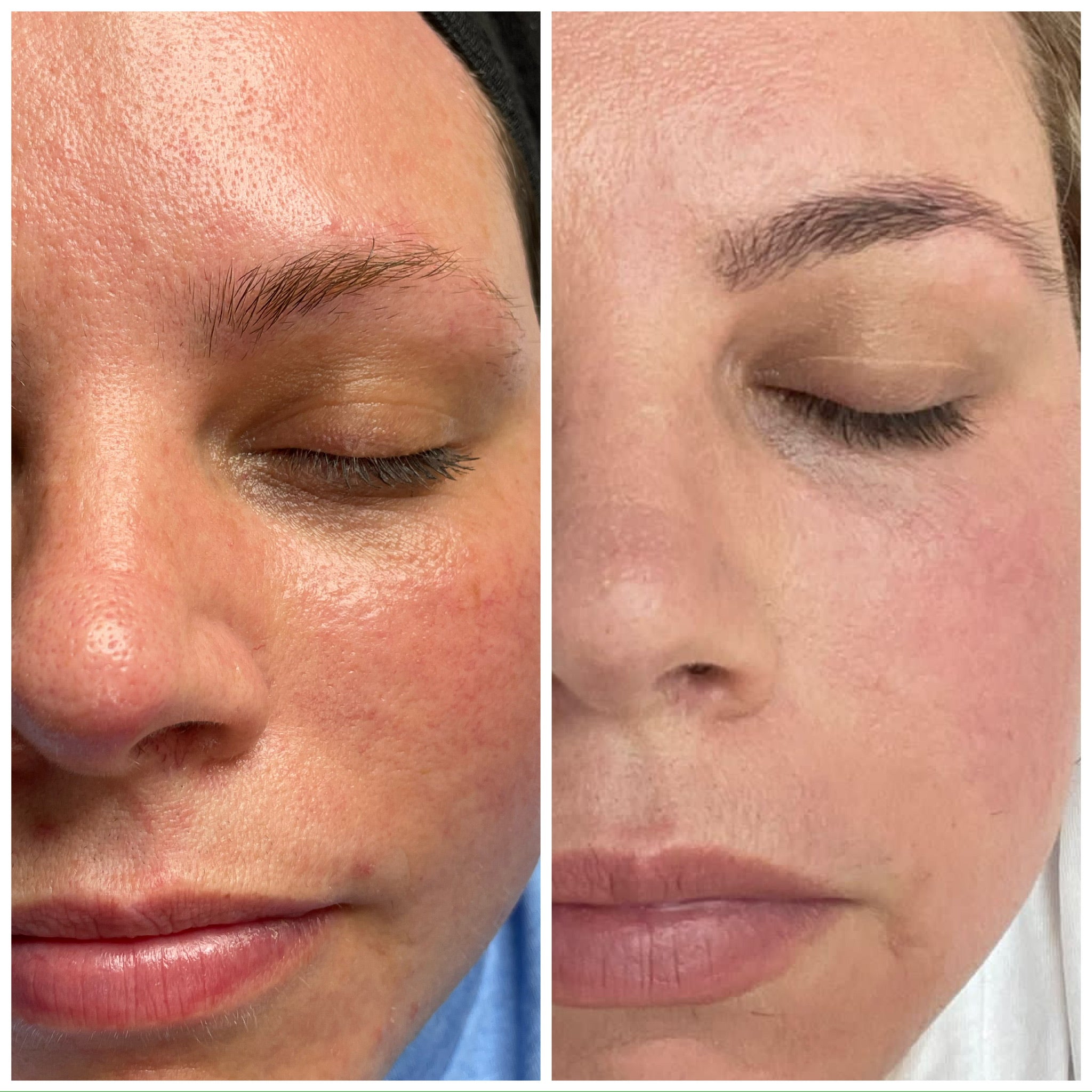 Microneedling Facial