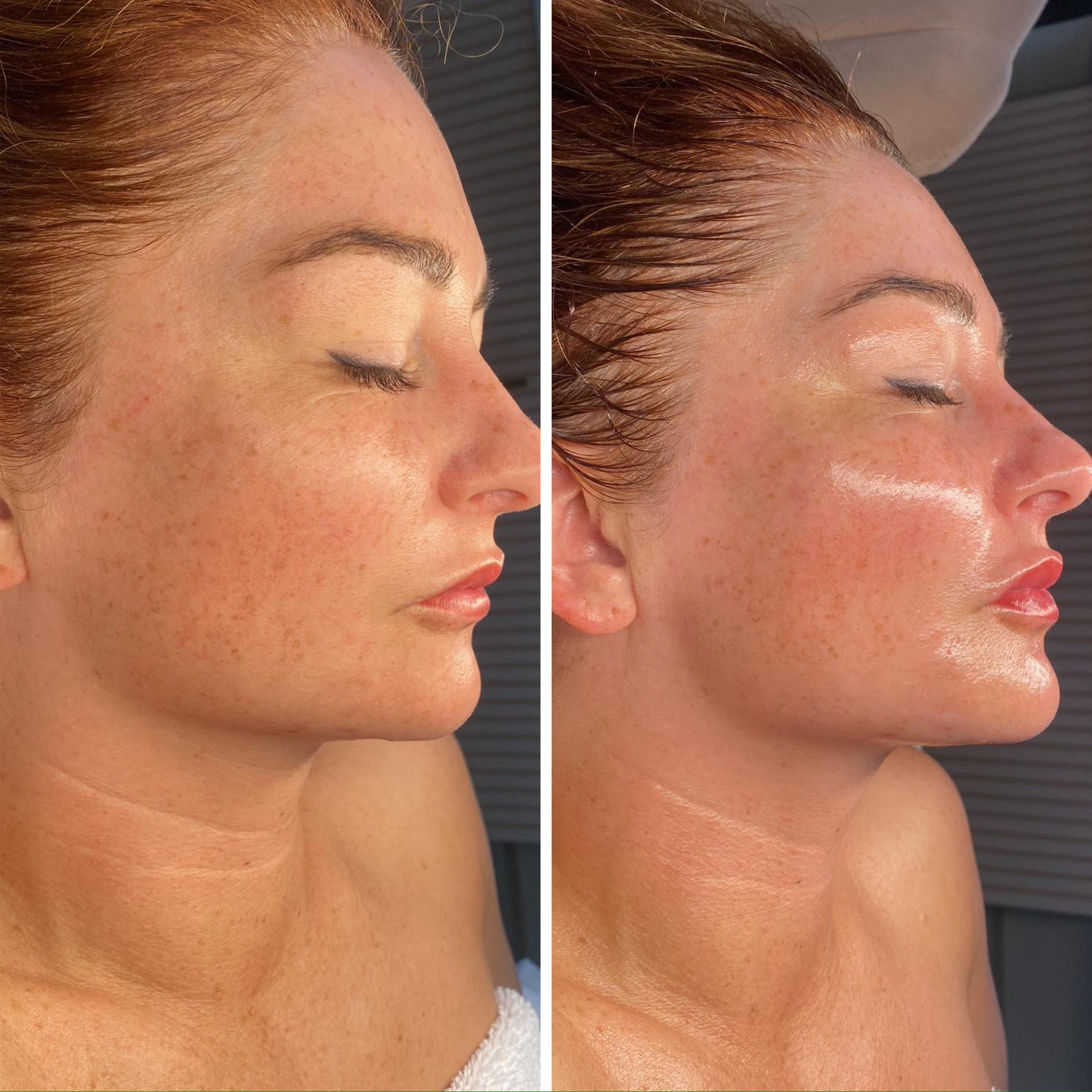 Luxury Lymphatic Lift facial