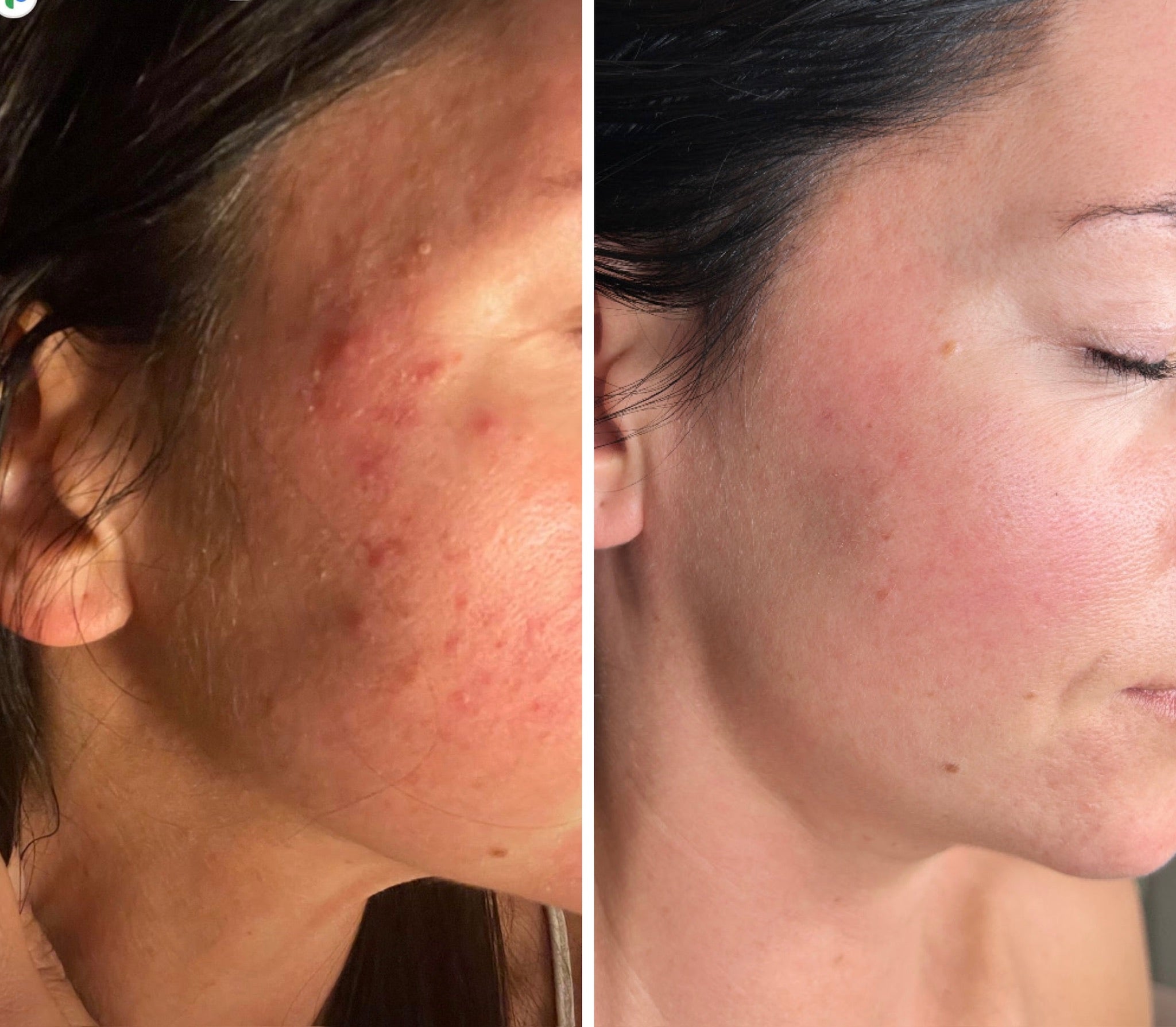 Microneedling Facial - Deluxe