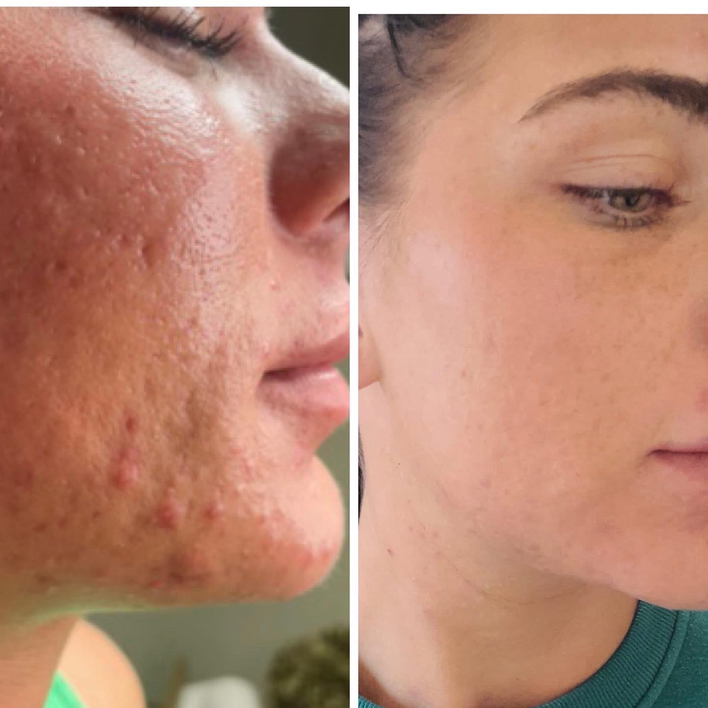 Microneedling Facial - Deluxe