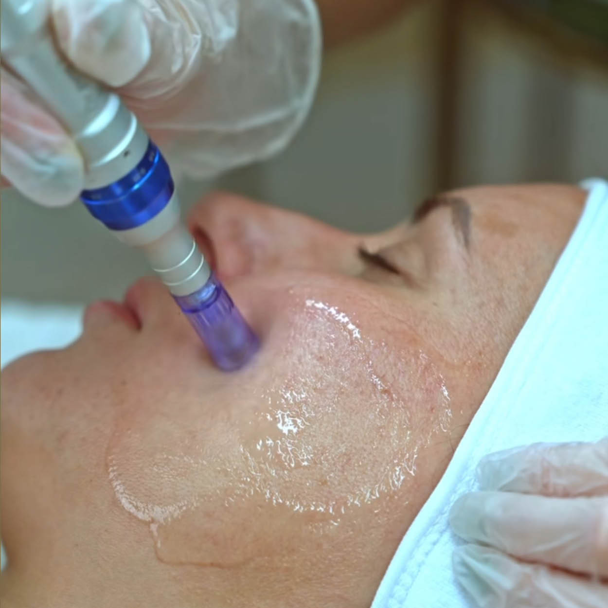 Microneedling Facial