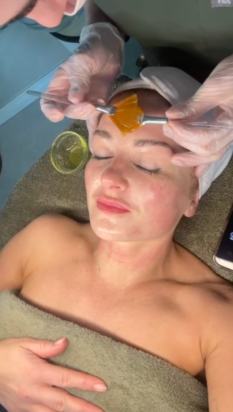 Microneedling Facial